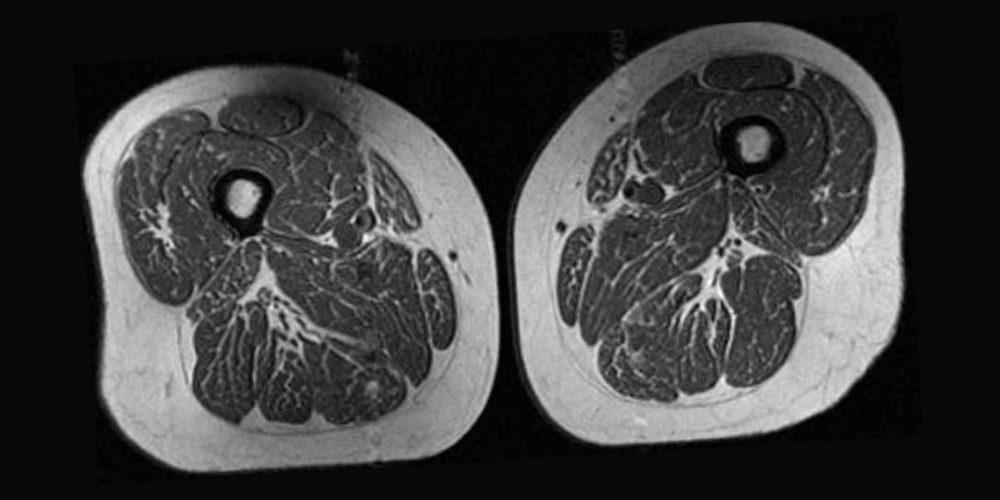 MRI Scans Reveal Fat “Marbling” in Muscles Linked to Ultraprocessed Foods